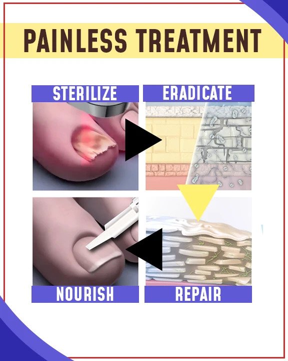 Antimykotische Blaulicht-Behandlungssets - Image 2