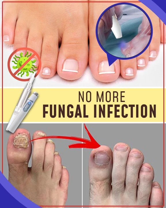 Antimykotische Blaulicht-Behandlungssets - Image 3