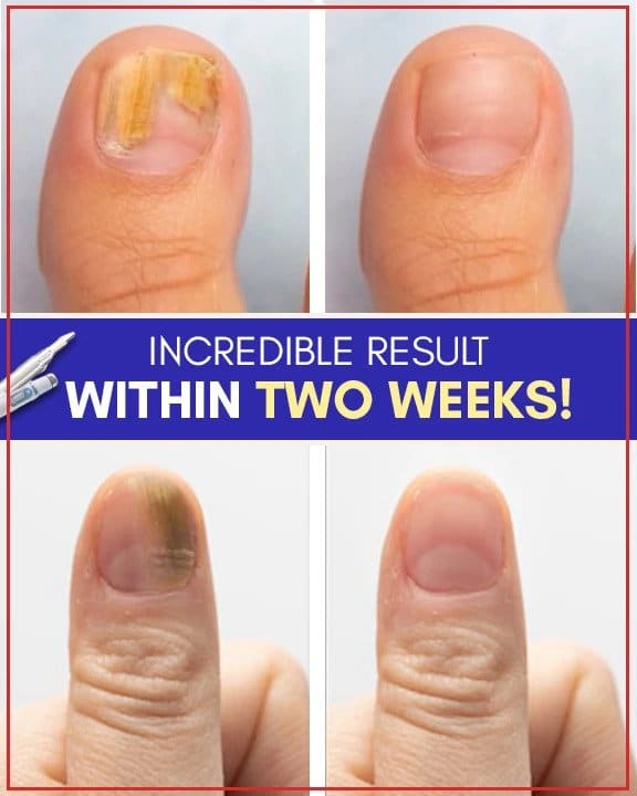 Antimykotische Blaulicht-Behandlungssets - Image 5